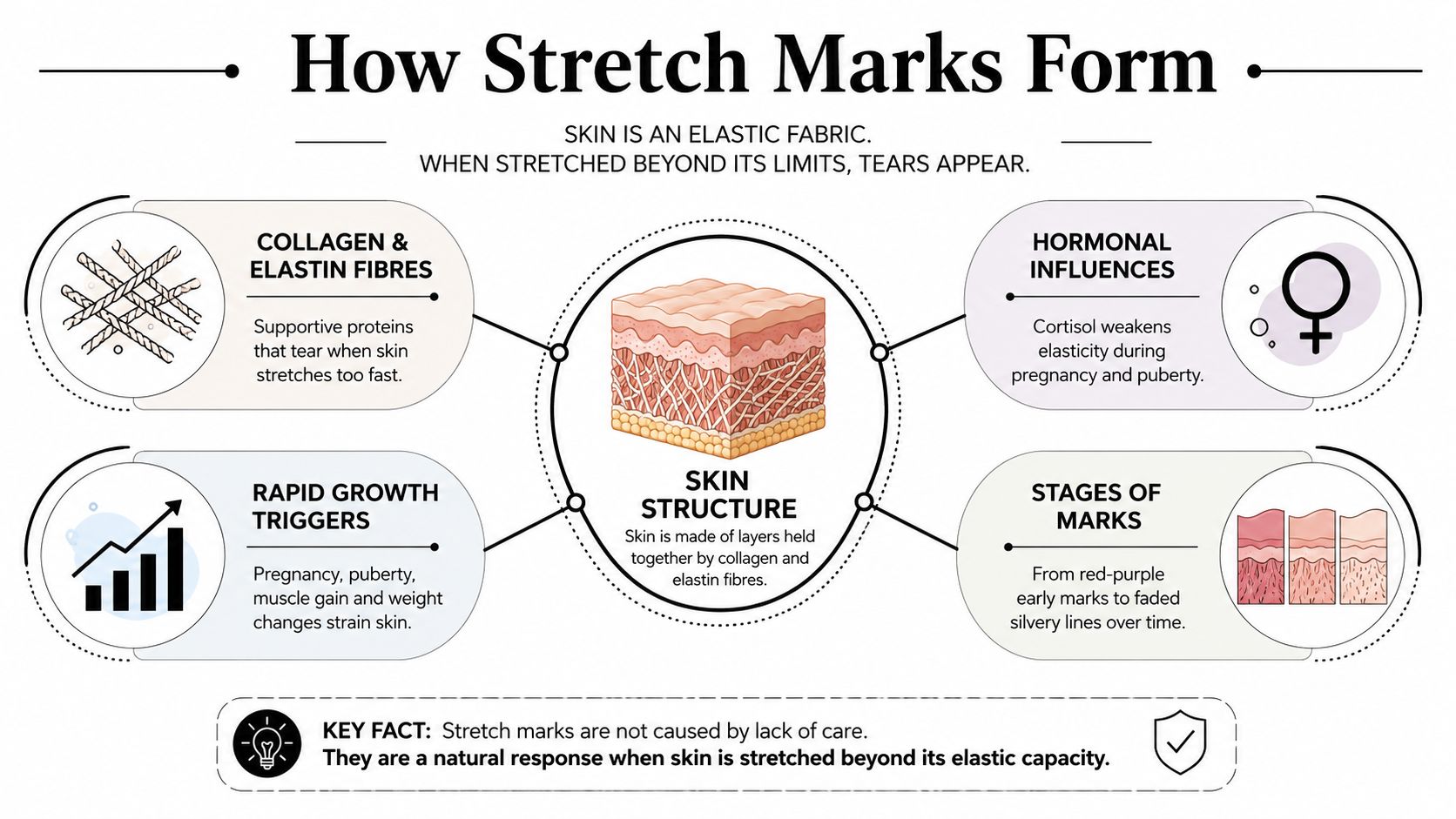An educational infographic explaining the biological causes and formation process of skin stretch marks.